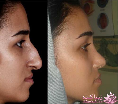 جراحی بینی - جراحی زیبایی